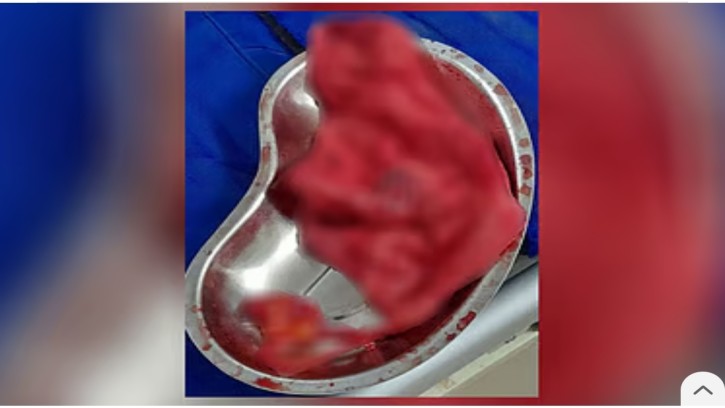  সিজারের ৬ মাস পর নারীর পেট থেকে বের করা হলো গজ কাপড়